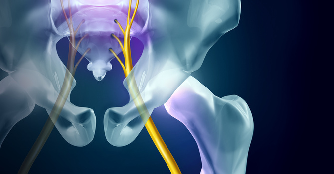 Sciatica